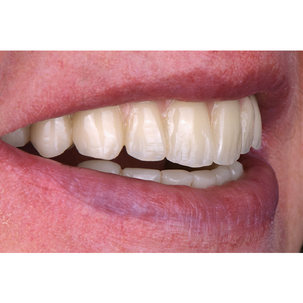 Vista lateral del material dental de aspecto expresivo a partir del VITA VIONIC DENT DISC multiColor.