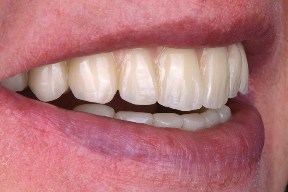 RESULTADO: Vista lateral del material dental de aspecto expresivo a partir del VITA VIONIC DENT DISC multiColor.