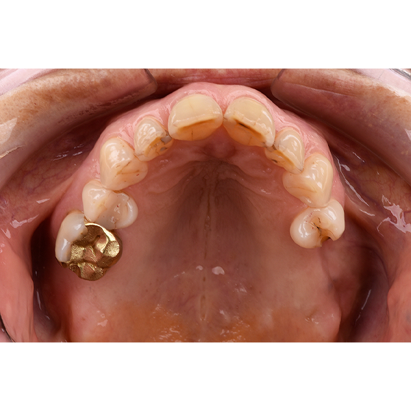 The initial situation with the missing teeth 17, 26 and 27.