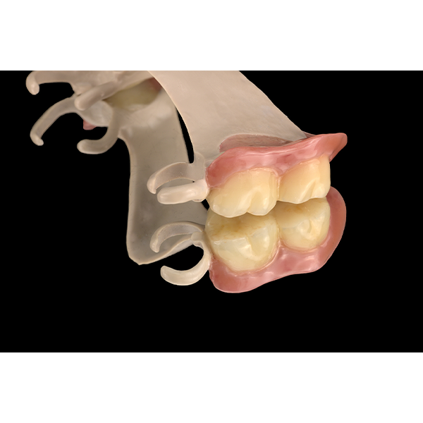 La transición cromática del material dental en los dientes 26 y 27 presentaba un aspecto absolutamente natural.