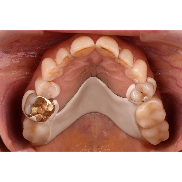 Occlusal view of the integrated partial denture.