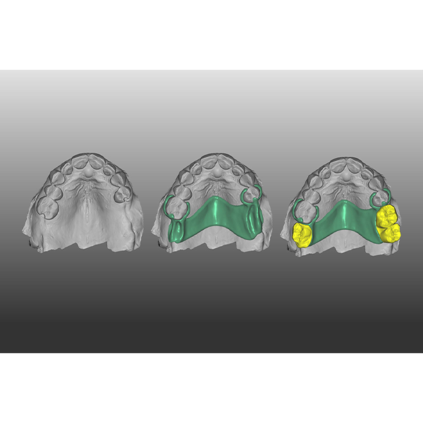The design of the denture components in the exocad software.