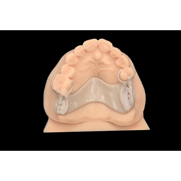 The framework of the partial denture was fabricated from PEEK, supported by CAD/CAM.