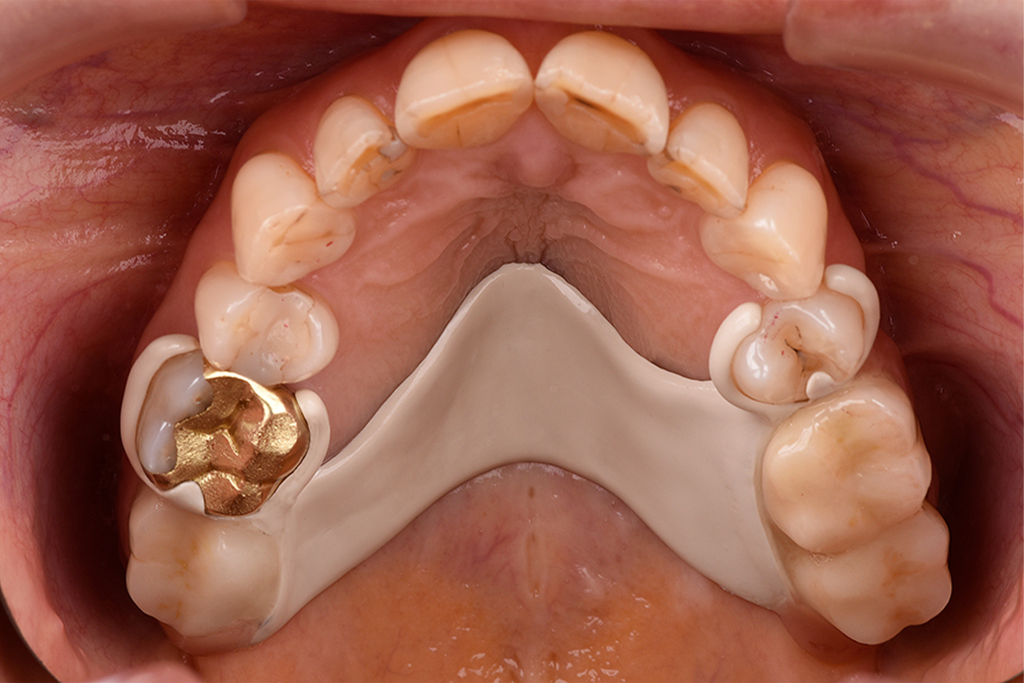 Occlusal view of the integrated partial denture.