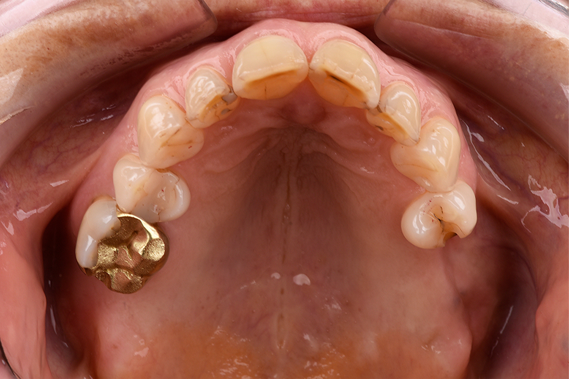 The initial situation with the missing teeth 17, 26 and 27.