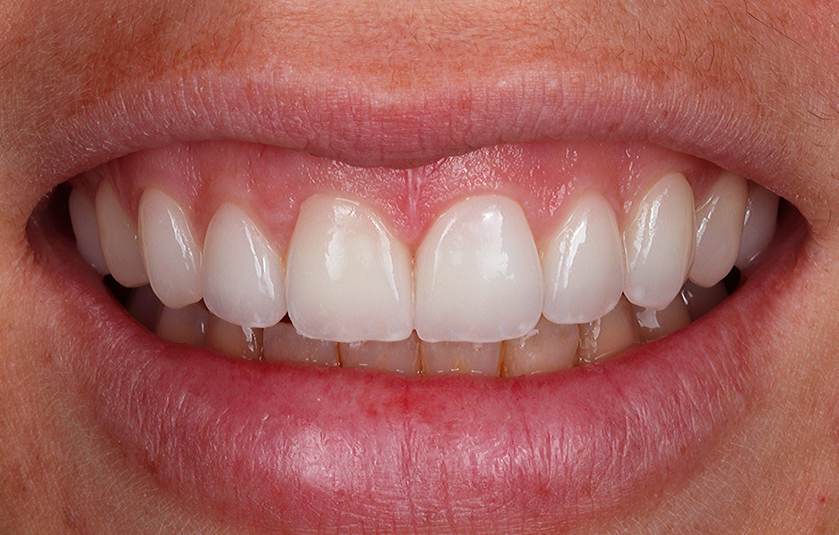 Dental technician Okke Kamps fixes VITA VIONIC VIGO teeth in a milled denture base.