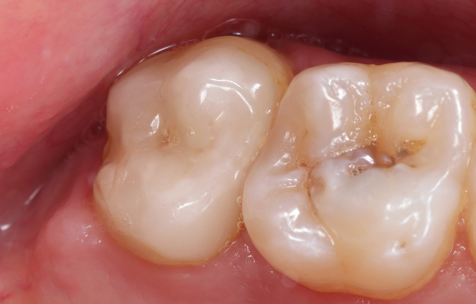 El protésico dental Okke Kamps fijando dientes VITA VIONIC VIGO en una base de prótesis fresada digitalmente.