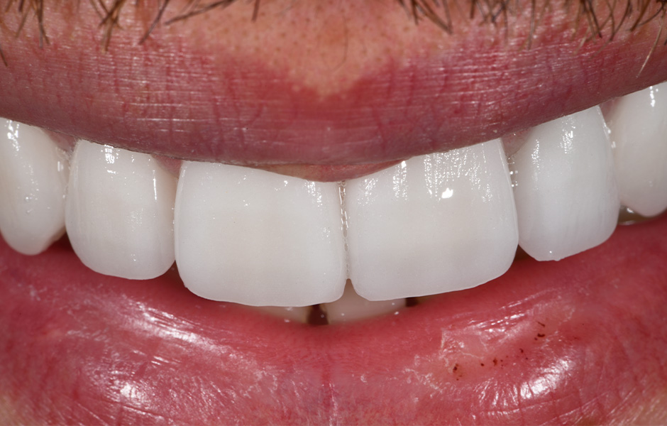 Dental technician Okke Kamps fixes VITA VIONIC VIGO teeth in a milled denture base.