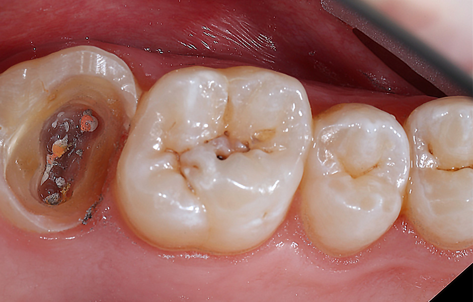 Le prothésiste dentaire Okke Kamps vérifie sur l'ordinateur le montage virtuel des dents