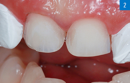 The minimally invasive preparation of 11 and 21 before the seating of the veneers.