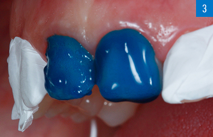 The enamel was etched with phosphoric acid in order to maintain a micro-retentive surface.