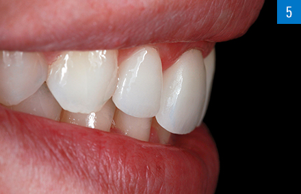 Der harmonisierte Zahnbogen in der Ansicht von lateral.