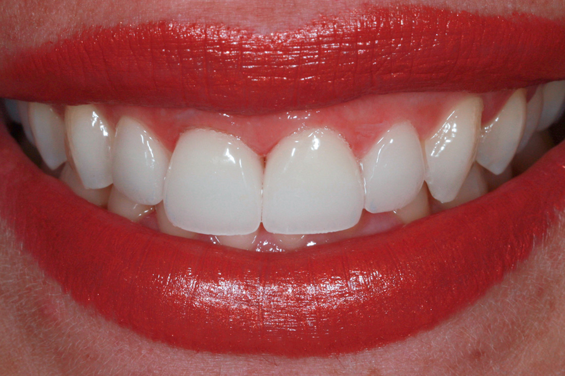 The highly esthetic, monolithic restoration results with veneers on 12 and 22.