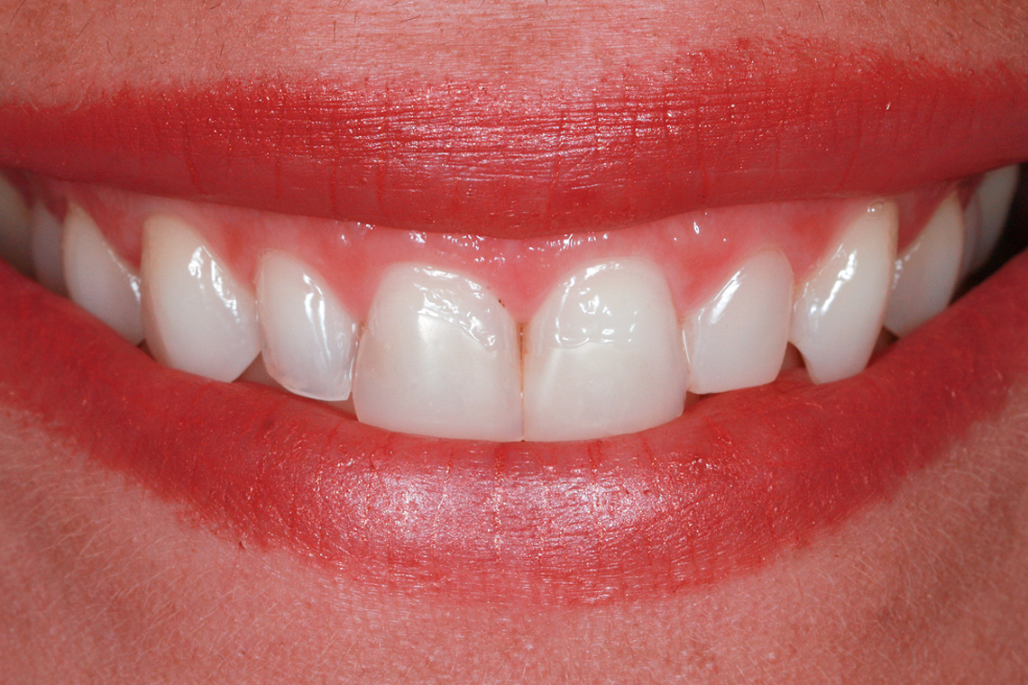Situazione iniziale: In seguito a un trauma, i denti 11 e 21 sono stati ricostruiti con un composito.