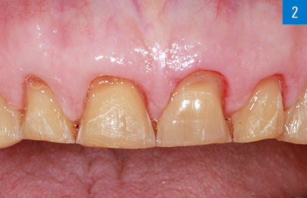 Situation in the upper jaw after guided mock-up preparation.