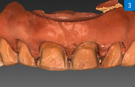 The scanned preparation of the upper jaw in the CAD software.