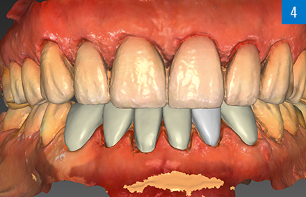 Die konstruierten Veneers im Ober- und Unterkiefer in der CAD-Software.