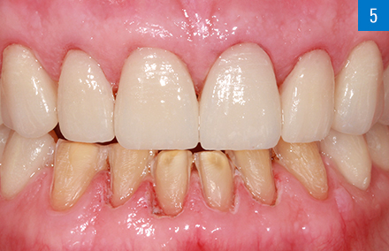 The veneers made from VITABLOCS TriLuxe forte following placement in the upper jaw.