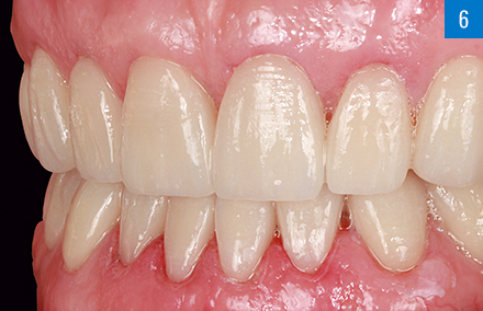 The highly esthetic rehabilitation following placement of the veneers in the lower jaw.