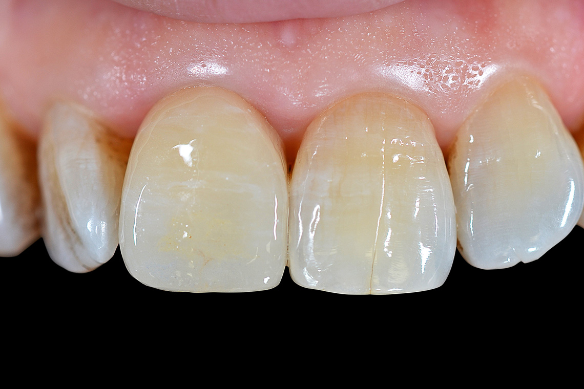 The highly esthetic result with a full crown made of VITABLOCS RealLife.