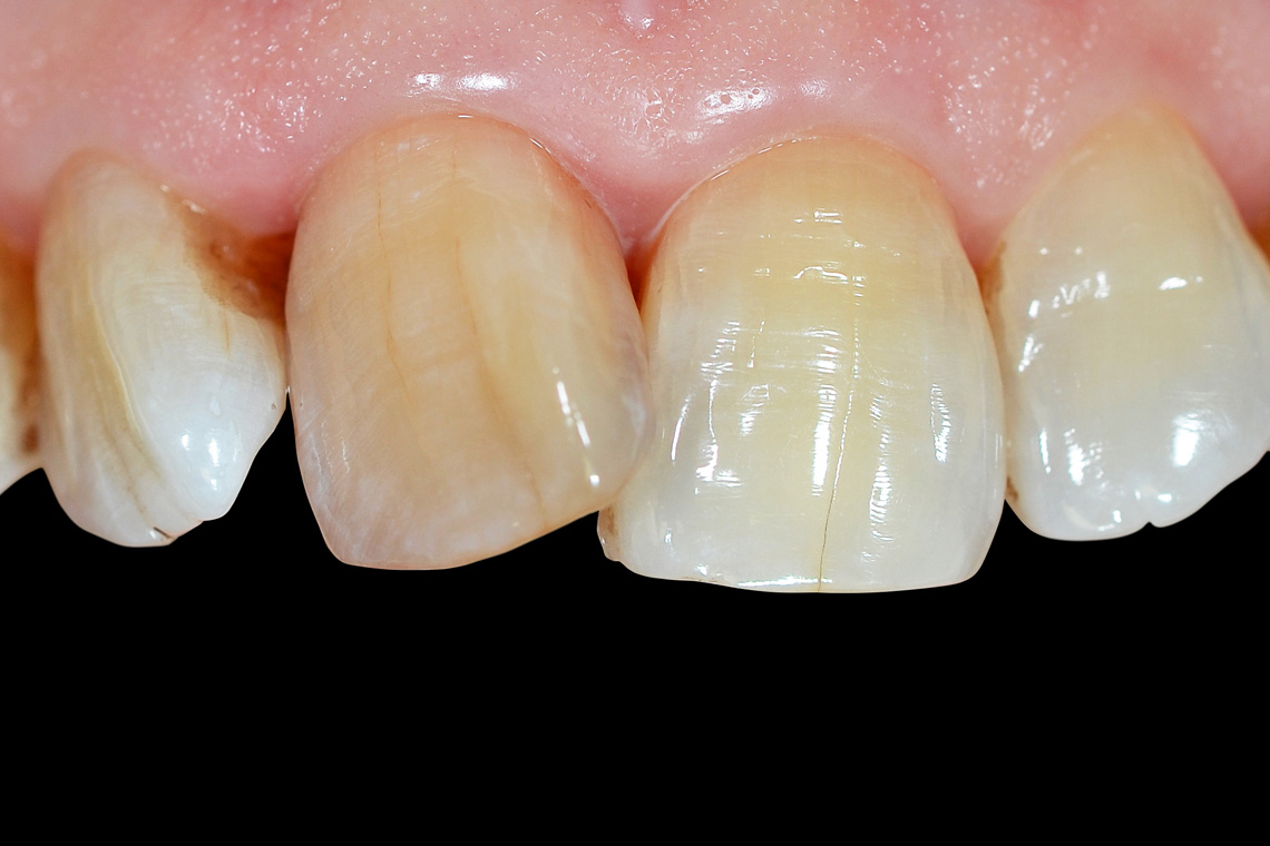 Initial situation with strongly rotated and non-vital middle incisor 11.