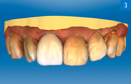 Dopo la scansione intraorale la forma della corona è stata progettata in modo virtuale.