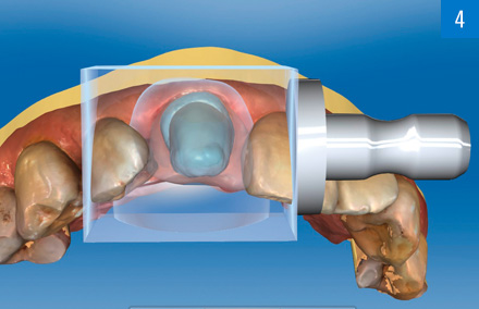 VITABLOCS RealLife è stato posizionato sulla preparazione.