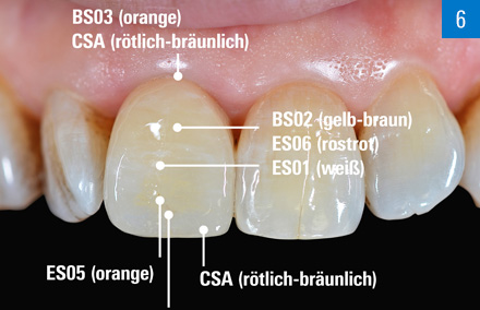 La couronne a été caractérisée individuellement avec les colorants VITA AKZENT Plus.