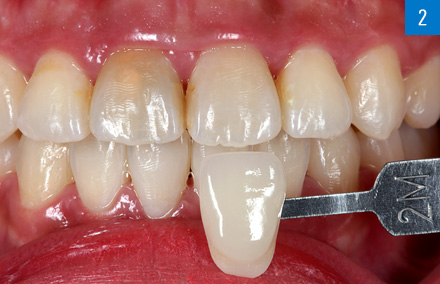 Die digital bestimmte Zahnfarbe 2M1 wurde mit dem entsprechenden Farbmusterstäbchen dokumentiert.