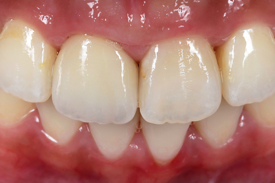 Within one session, a highly esthetic crown restoration was achieved using VITABLOCS TriLuxe forte.