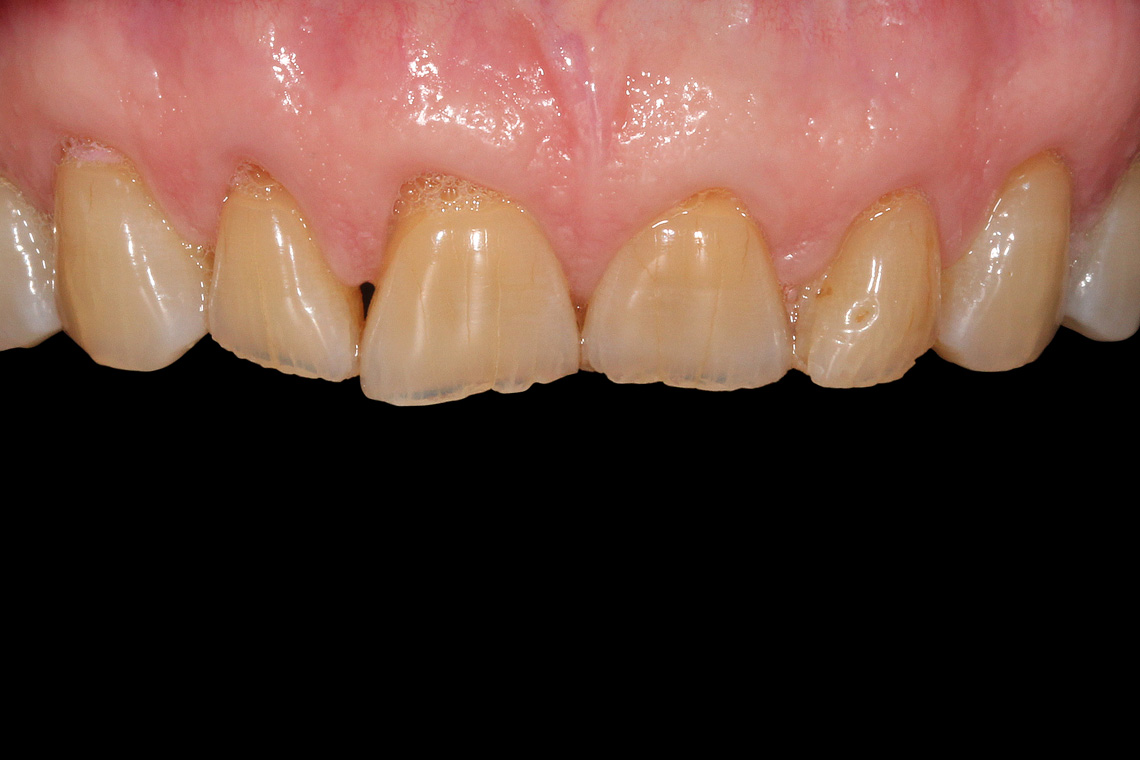 Situation initiale : une denture endommagée par l'abrasion et l'érosion.