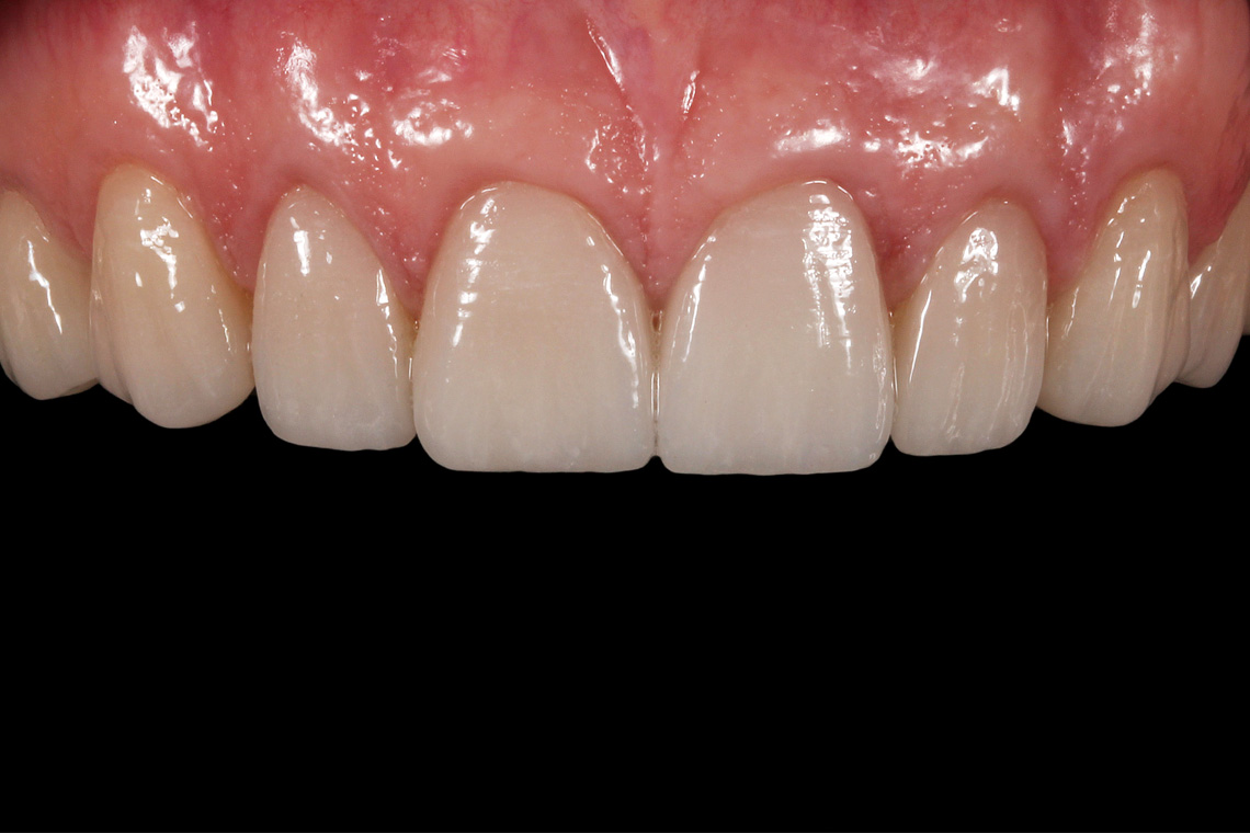 Veneers aus der Feldspatkeramik VITABLOCS TriLuxe forte eineinhalb Jahre nach der Eingliederung.