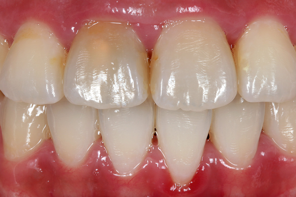 Ausganssituation: Nach einer Wurzelkanalbehandlung war Zahn 11 stark verfärbt.