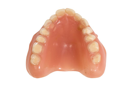 The esthetically and functionally insufficient prostheses showed massive occlusal abrasions.