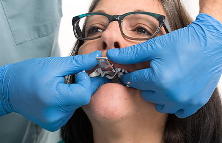 The alveolar ridges were molded in the maxilla and mandible with prefabricated anatomical trays.