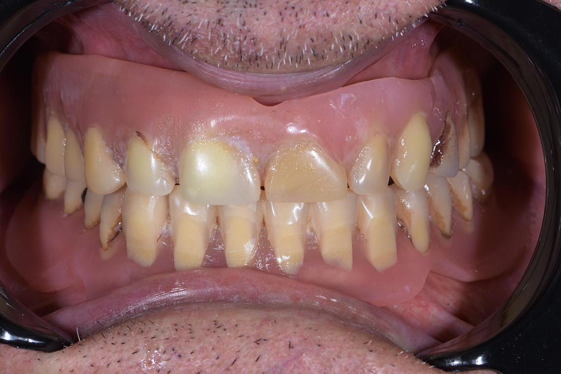 73-year-old patient was unhappy with the stability of his full denture restoration.