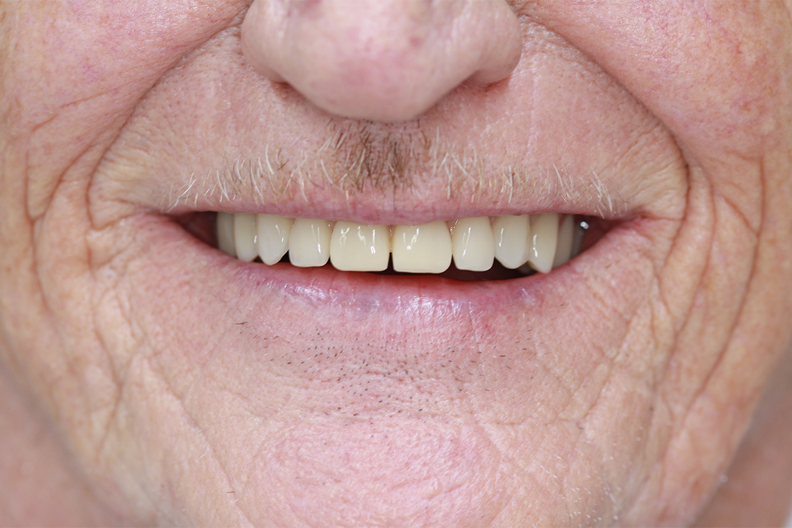 RESULT: The newly created anterior tooth esthetic with VITAPAN EXCELL.