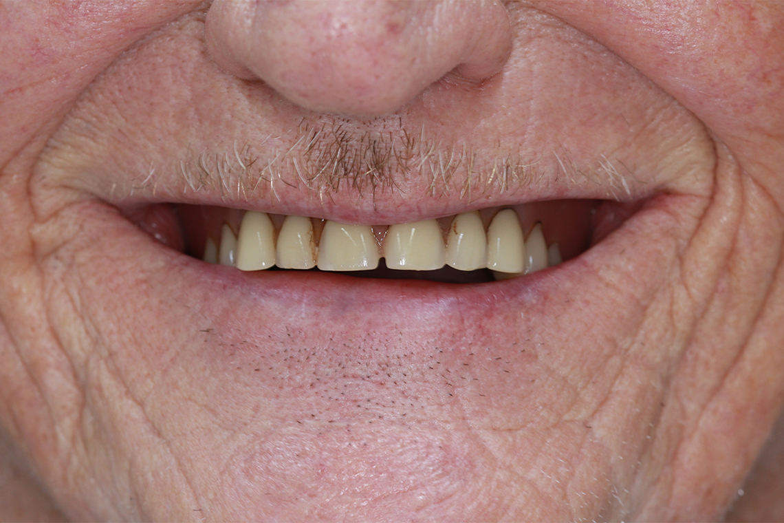 SITUAZIONE INIZIALE: Gli antiestetici denti anteriori dell’arcata superiore prima della nuova protesi.