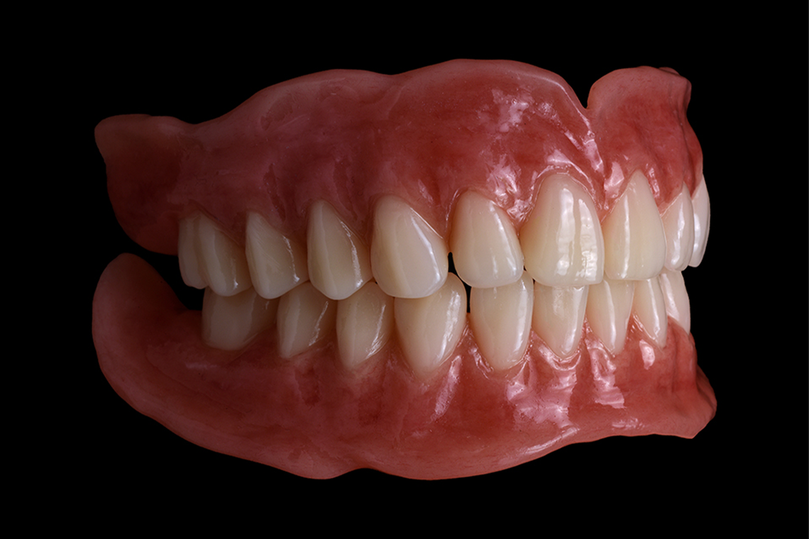 RESULT: The new full denture restoration during clinical integration.