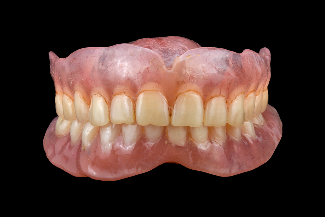 INITIAL SITUATION: Extraorally, the old dentures showed esthetic and functional deficits in occlusion.