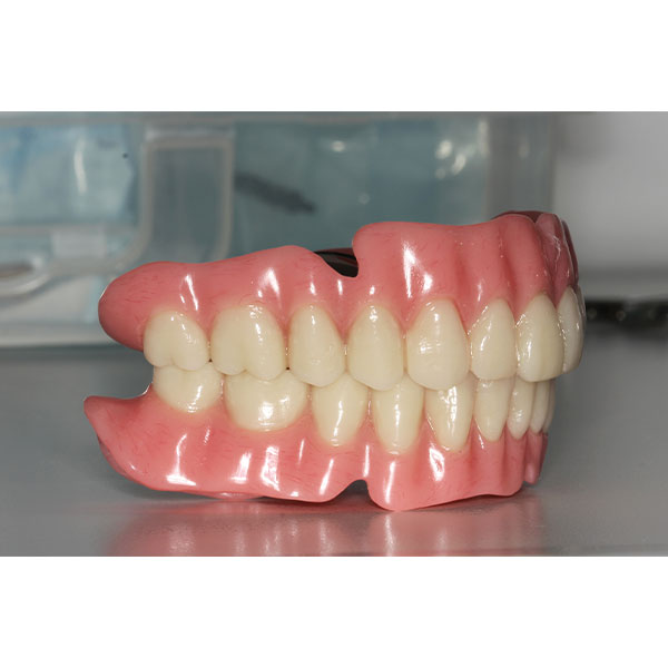 The implant- and mucus membrane-supported full denture after implementation in resin.