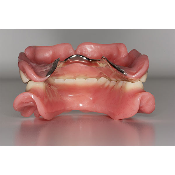 The denture in the upper jaw, reinforced with a metal framework, was designed to be palate-free.