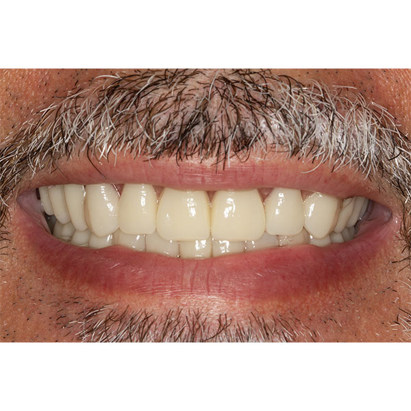 The surface texture of the VITAPAN EXCELL was lightly polished to achieve an age-appropriate appearance.