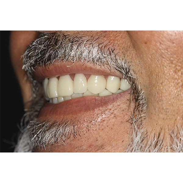 A healthy periodontium was simulated  with the papilla design.