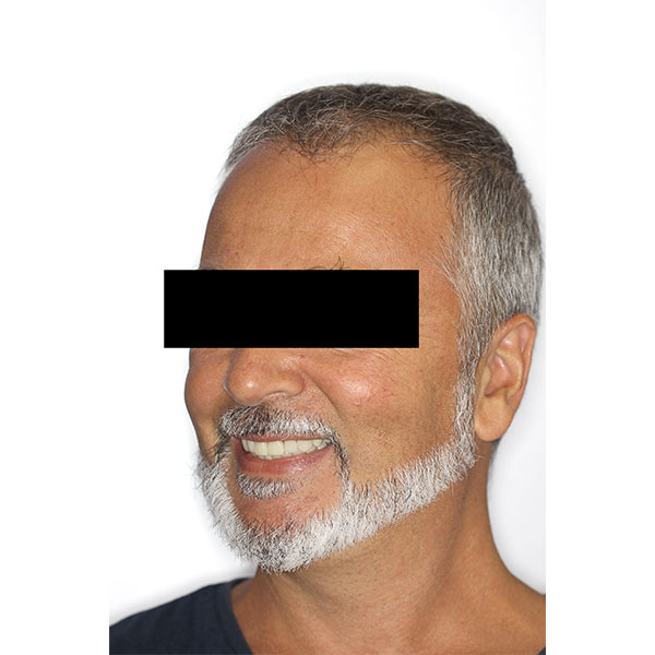 The patient was very enthusiastic about his new, youthful smile