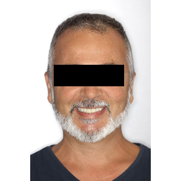 The patient was very enthusiastic about his new, youthful smile