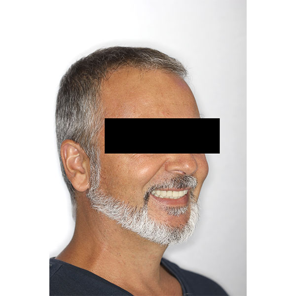 The patient was very enthusiastic about his new, youthful smile