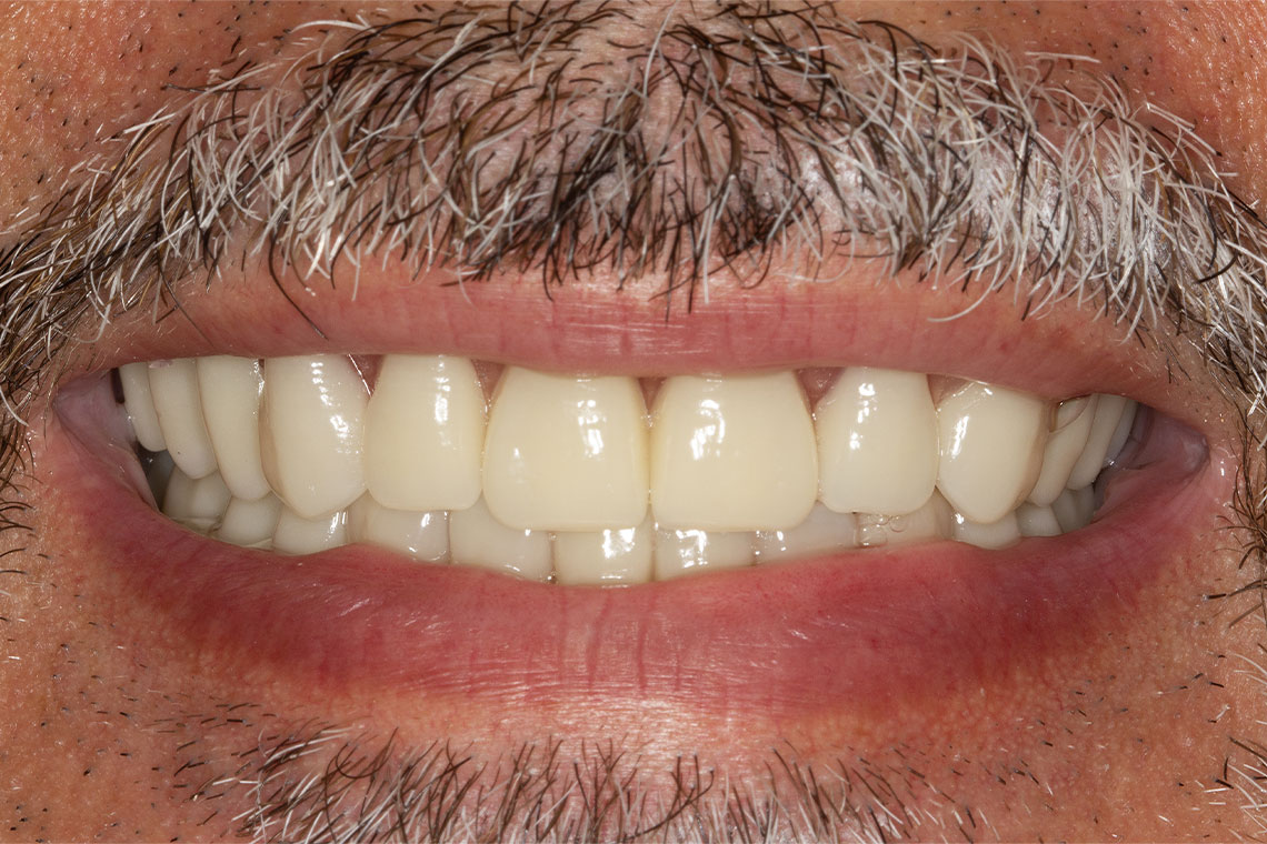 The surface texture of the VITAPAN EXCELL was lightly polished to achieve an age-appropriate appearance.