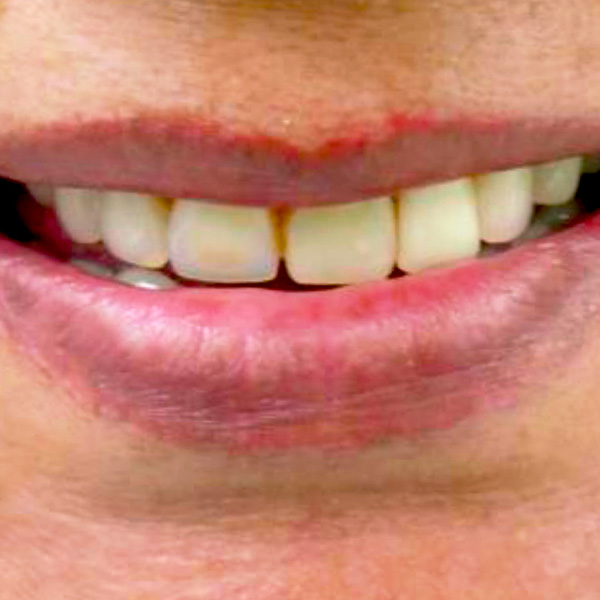 The initial situation with the uneven line of the incisal edges in the upper jaw.