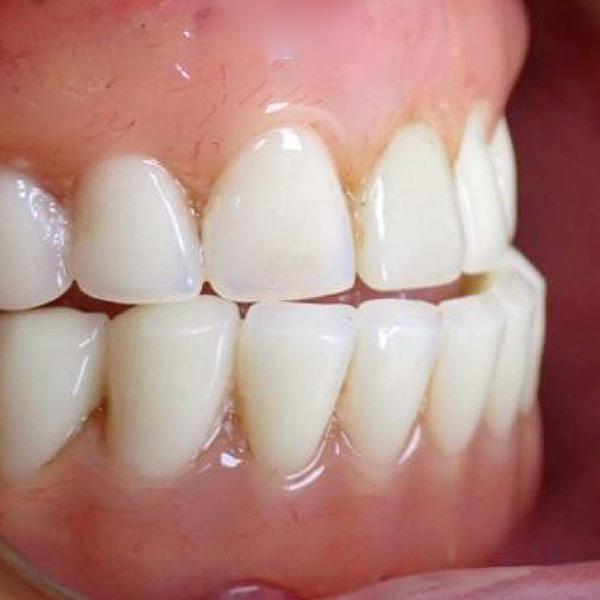The progenic bite situation with occlusal stress on particular points.